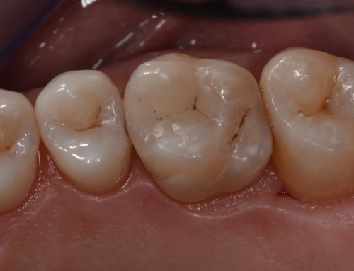L’odontoiatria conservativa: alla base di ogni buon dentista